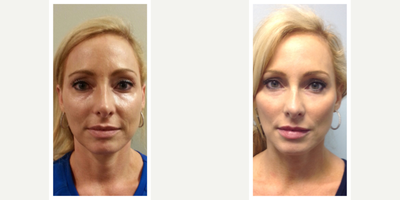 45-54 year old woman treated with JuVaShape - Radio-Frequency JuVaShape (one session) fat melting for the jowls + skin tightening for the entire face