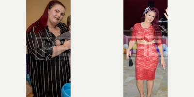 25-34 year old woman treated with Gastric Bypass, Gastric Sleeve Surgery - She lost 42 kilos in 18 months.