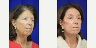 3478 Facelift, TCA Peel, Blue Peel, Brow Lift - 65-74 year old woman treated with Facelift, TCA Peel, Blue Peel, Brow Lift