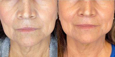65-74 year old woman treated with AccuTite - FACETITE Minimally invasive neck and lower face contouring. FaceTite provides dramatic improvement in skin laxity on the face and neck, which was previously only attainable through a surgical procedure such as a facelift. FaceTite utilizes minimally invasive radio-frequency energy to melt fat and tighten skin. By avoiding a facelift excisional procedure, patients will be scar free and will benefit from reduced post-procedural swelling and discomfort. This is a less traumatic process with a natural looking final result. Results can be seen immediately, with best results noticeable after 6-12 weeks, but continuing to improve for a year. WHAT IS FACETITE? An advanced contouring system to treat a patients face and their small areas. FaceTite is minimally invasive and is the next best alternative to facelifts without invasive surgery. You can work safely in the sub-dermal plane as you contract and contour tissue using RF technology. WHAT IS FACETITE? FaceTite provides a dramatic improvement in skin laxity on the lower face and neck, which was previously only attainable through a surgical procedure such as a facelift. FaceTite utilizes minimally invasive radio-frequency energy to melt fat and tighten skin. HOW IS THIS BETTER THAN A FACELIFT? By avoiding a facelift excisional procedure, patients will be scar free and will benefit from reduced post-procedural swelling and discomfort. This is a less traumatic process with a natural looking final result. HOW QUICKLY WILL I SEE RESULTS? Results can be seen immediately, with best results noticeable after 6-12 weeks. This patient came in for her 3 month photo and hasn't been back since. If she looked this good after only 3 months, can you imagine how great her results are now!?!  WHAT KIND OF PROCEDURE CARE IS REQUIRED? FaceTite is a minimally-invasive procedure performed under local anesthesia in our office. Post-procedure, the patient can go home and resume regular activities shortly after. Wearing a compression garment is required for best results, but we will give you all the details at time of consultation.