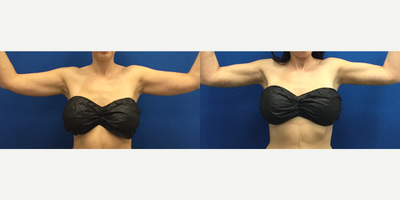 Slim Lipo of the Arms - Before & 2 Days Post-Op Slim Lipo of the Arms by Dr. Justin Yovino&nbsp;