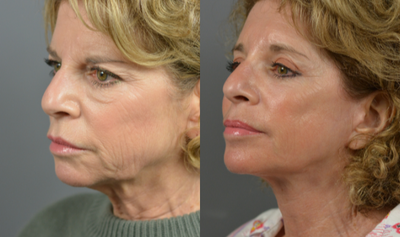 55-64 year old woman treated with SMAS Facelift - SMAS Facelift before and after