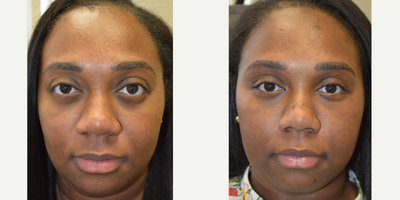 31 year old female underwent bulging eye and lower eyelid retraction surgery. - 31 year old African American female, with inherited bulging eyes due to shallow orbits and lower eyelid retraction with sclera show. She underwent cosmetic orbital decompression and lower eyelid retraction surgery. Before and 3 months after transforming eye plastic surgery photos are shown. (Procedure has risks that need to be considered.)