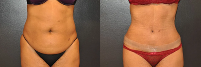 Woman treated with Tummy Tuck - Woman treated with Tummy Tuck
