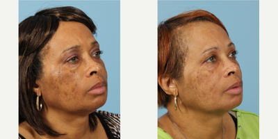 45-54 year old woman treated with ThermiTight - 45-54 year old woman treated with ThermiTight