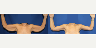 45-54 year old woman treated with Arm Lift - This patient was left with sagging skin of her arms after losing a massive amount of weight. She desired skinny arms after her weight loss. Dr. Katzen performed an arm lift in Beverly Hills to tighten her arms after her weight loss. She is extremely happy with her results.