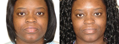 Ultherapy - 
	Before and 6 Weeks After Ultherapy

