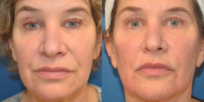 45-54 year old woman treated with Perlane - Before and After Perlane injections for enhancement of the middle face, temples, periocular region, marionettes, lip boarders, and prejowl.