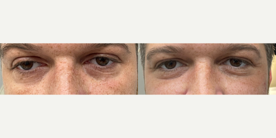 35-44 year old man treated with Upneeq - Upneeq Treatment done on eyes