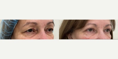 55-64 year old woman treated with Eyelid Surgery, Ptosis Surgery - Bilateral upper blepharoplasty and levator advancement.