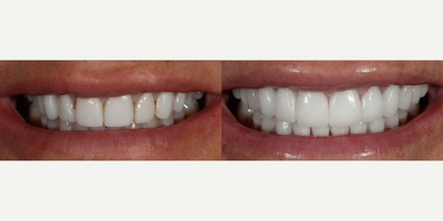 Woman treated with Porcelain Veneers, Tooth Repair, Dental Crown, Smile Makeover - This patient had 8 upper existing old porcelain restorations (a combination of veneers and crowns). She had them redone 3 timesthis was her fourth. Time for an upgrade. She wasnt happy with the color size or shape. We replaced them with 12 upper porcelain restorations and 8 lower. We did the lower to support her bite and restore the worn tooth structure. We got vibrant natural results that complement her face.