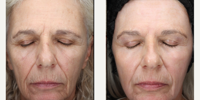 55-64 year old woman treated with Scar Removal, Laser Scar Removal - Full face laser resurfacing