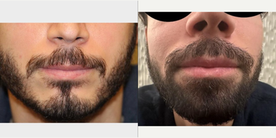 35-44 year old man treated with Beard Transplant - 42 year old male 2 years post FUE transplant to thicken the beard