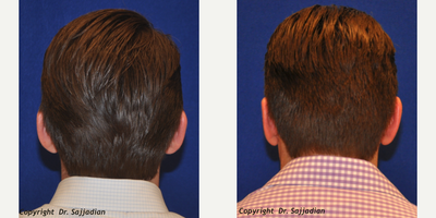 Ear Surgery - Ear Surgery