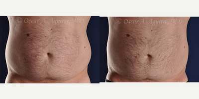43 yo male treated with CoolSculpting - 43 yo male treated with CoolSculpting-12 weeks post treatment #2 Submental, Upper/Lower Abdomen, Bilateral Flanks and Bilateral inner thighs.