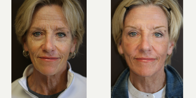 Mini Vidalift, Enigmalift Surgery and Laser Resurfacing - Mini Vidalift with Enigmalift scarless lower eye bag removal and photodynamic laser resurfacing.
