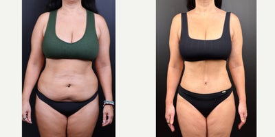 45-54 year old woman treated with Tummy Tuck, Liposuction, Diastasis Recti Repair - This 49 year old 5'3 172 pound woman had an abdominoplasty, (tummy tuck) with flank liposuction and rectus diastasis repair performed. Her results are shown 6 months after surgery.