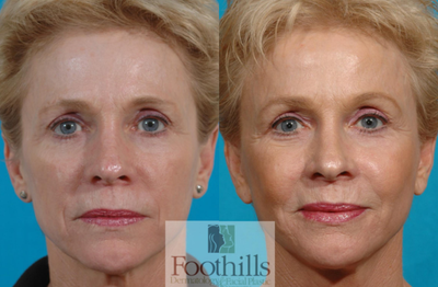 55-64 year old woman treated with Cheek Augmentation - 55-64 year old woman treated with Cheek Augmentation