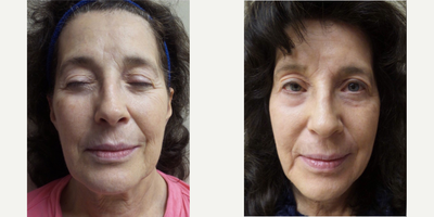 45-54 year old woman treated with Pixel Laser - Woman treated with Erbium with pixel