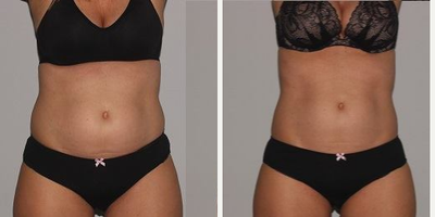 45-54 year old woman treated with i-Lipo - Results after just 8 iLipo sessions. These treatments are completely painless and are performed twice weekly for 4 weeks.