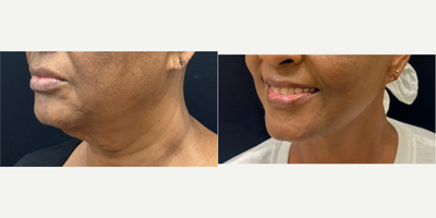 45-54 year old woman treated with Facelift, Deep Plane Facelift - 53 y.o female who underwent deep plane facelift, neckift. She was awake yet comfortable for the procedure