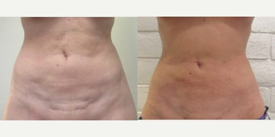 Woman treated with BodyTite - THIS PATIENT RECEIVED THE FOLLOWING PROCEDURES:BODYTITEABDOMEN LIPOSUCTION REVISION & CELLULITE REDUCTION