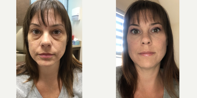 35-44 year old woman treated with Restylane Lyft Immediate Post Op - 35-44 year old woman treated with Restylane Lyft Immediate Post Op