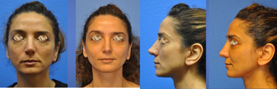 Revision (3rd) rhinoplasty - This women had a prior rhinoplasty and then a revision by the same surgeon.  She was still dissatisfied with the tip shape and over projection.  She desired a revision to address these issues as well as other subtle defects.  There was also a component of the surgery that addressed breathing problems.  An open approach with rib graft was used.  Given that his is her 3rd surgery even more time is required for edema to improve but the results are becoming evident.