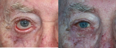 87 year old male treated for ectropion - 	This is an 87 year old male referred to me secondary to ectropion (droopy lower eyelid) after having a skin cancer removed. The patient was experiencing dry eye and could not completely close his right eye. He underwent a full thickness skin graft with lateral canthoplasty to restore vertical height to the lower lid.