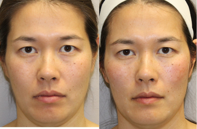 35-44 year old woman treated with Non Surgical Face Lift - I placed novathreads for a midface lift.