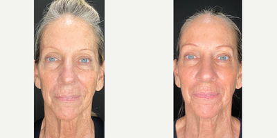 55-64 year old woman treated with Opus Plasma, IPL, Fractional Laser - This client wanted to address her skin laxity and hyper-pigmentation. We chose to do a series of combination treatments. This is 4 weeks after her 3rd treatment!