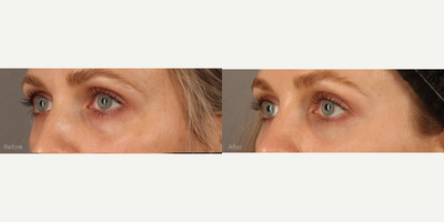 Scarless Lower Bleph (Eyelid Lift) with Fat Transfer and CO2 Laser Resurfacing - This beautiful 31-year-old female struggled with lower lid bags that were worsening with age. A transconjunctival (Scarless) lower lid blepharoplasty was performed to reduce the bags. Finesse multi-level fat transfer was performed to create mid-facial and lower lid contours. Fractional CO2 laser resurfacing was performed to tighten and rejuvenate the skin around the eyes.