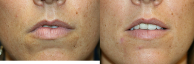 Lip Reduction to Lower Lip after Trauma - 
	Patient had a traumatic experience that created scar tissue on one side of her lower lip and caused an imbalance in symmetry. She had a lip reduction on the one side of her lower lip to return her lips to a more natural and even shape.
