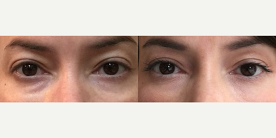 Woman treated with PRP Injections - This patient was treated with PRP Injections under the eye. PRP is full of stem cells and growth factors. When it gets deposited under the skin, it immediately starts working by generating volume, collagen, and elastin. This eventually corrects the volume which was lost completely naturally and give longer lasting results.