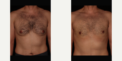 One Stitch Gynecomastia Surgery - The patient was concerned about his chest. He has vaser liposuction and manual breast tissue removal by one small incision.