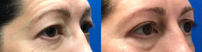 45-54 year old man treated with Eyelid Surgery - This woman underwent upper blepharoplasty surgery to lift her eyelids. As you can see she got great results!
