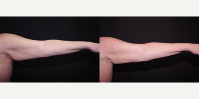 55-64 year old woman treated with Smart Lipo - 55 year old female received Smart Lipo to arms; photos depict the patient's results 3 weeks post-op.