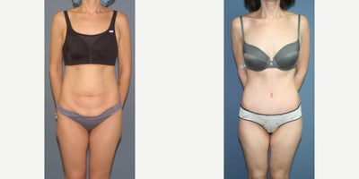 25-34 year old woman treated with Tummy Tuck - Full tummy tuck muscle repair