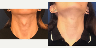 18-24 year old woman treated with Adam's Apple Reduction - MTF transgender female 1 month after Trach Shave