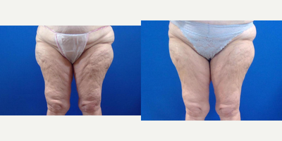 65-74 year old woman treated with Acoustic Wave Therapy - 65-year old female. Sixteen sessions of AWT.