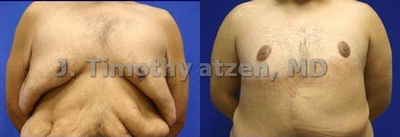 Male Breast Reduction - Male Breast Reduction after massive weight loss. - Individual Results May Vary