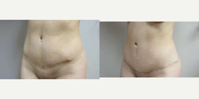 Tummy Tuck Revision - Patient had a tummy tuck 7 year ago and was unhappy with the results. The doctordiscussed removing the dog ears, lowering the incision and smoothing out the abdomen.