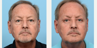 55-64 year old man treated with Eyelid Surgery, Double Eyelid Surgery - This 61-year-old patient was bothered by the loose skin above his eyes and worried about the aged, swollen look under his eyes. Dr. Wise conducted an upper blepharoplasty and lower blepharoplasty to address these concerns. As a result, the patient now has more youthful, smoother, and tighter eyelids. The post-operative results are visible two months after the procedure.