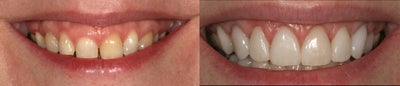 Gum re contouring - 
	This patient presented to our offices with wishes to have brighter and younger smile that showed off her radiant personality when she smiled. Her smile is often described as &quot;gummy&quot; which means too much gum tissue is covering the surface of her teeth. Gum re contouring was performed to remove the excess tissue. The teeth were then prepared for all porcelain veneers.&nbsp;
