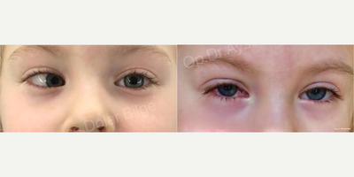 Kid treated with Strabismus Surgery - Kid treated with Strabismus Surgery