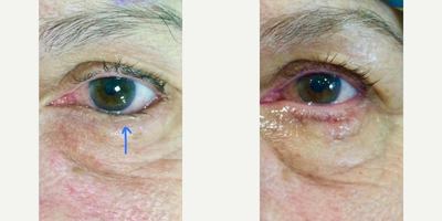 Man treated with Eyelid Retraction Repair, Eyelid Surgery - Man treated with Eyelid Retraction Repair, Eyelid Surgery