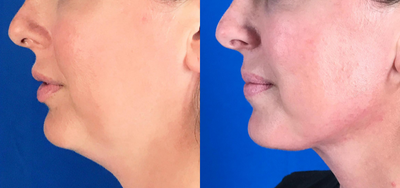 25-34 year old woman treated with Velashape and Liposuction - 25-34 year old woman treated with Chin liposuction and 4 treatments of VelaShape.