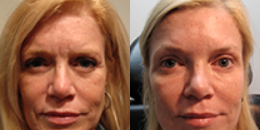 45-54 year old woman treated with Non Surgical Face Lift - Patient had 2 syringes of Radiesse, 1 syringe of Belotero, 1 syringe of Juvederm, and 35 units of Botox.