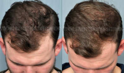 18-24 year old man treated with Hair Loss Treatment - This patient was treated using PRP Hair Restoration. PRP is a revolutionary step in utilizing your own body's plasma to promote natural rejuvenation and cellular growth. This patient's pictures are taken after 2 rounds of PRP treatment the morning of his 3rd round.