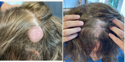 55-64 year old woman treated with Cyst Removal - sebaceous cyst from the temporal area